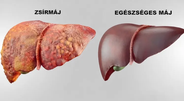 Zsírmáj egy egészséges máj mellett
